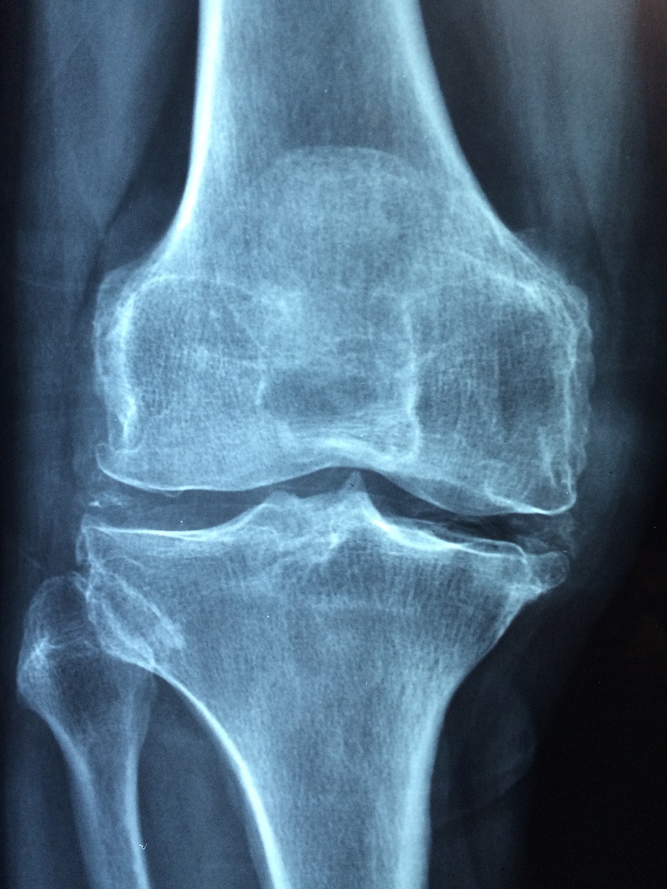 osteoarthritis